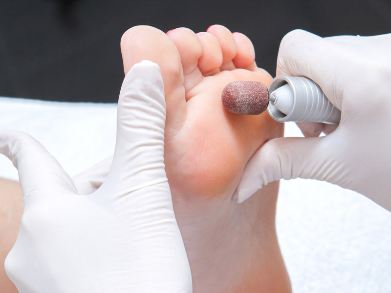 Как распознать микоз стопы? Симптомы грибка пальцев ног