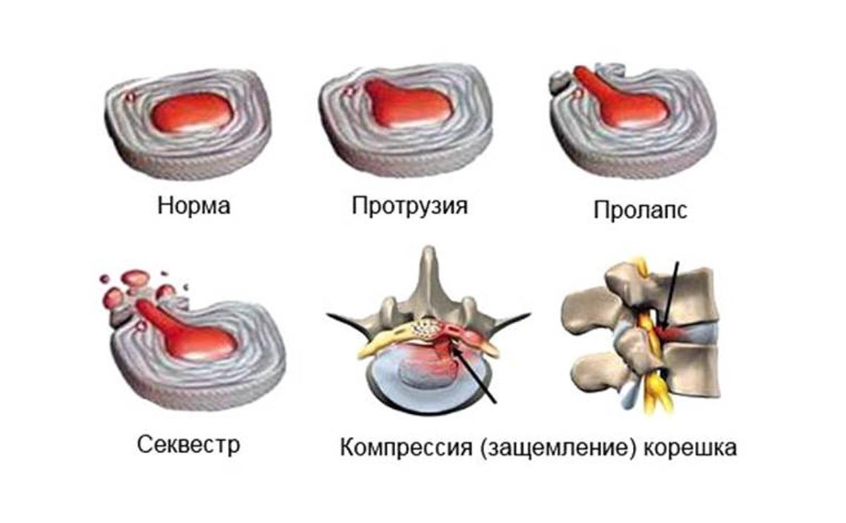 Выбухание межпозвоночного диска