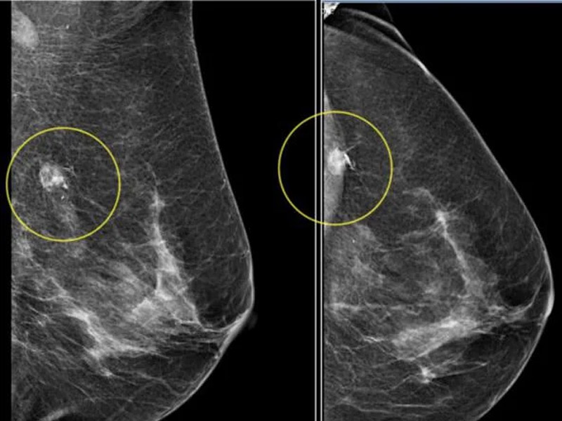Лечение диффузно кистозной. Маммография фиброаденома. Маммография фиброаденома снимок. Фиброаденома молочной железы маммограмма. Фиброзно-кистозная мастопатия маммография.